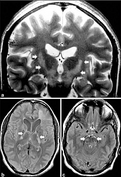 Coronal T2 (Human Brain MRI)